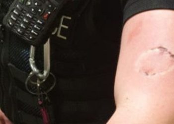 Μεθυσμένη γυναίκα δάγκωσε αστυνομικό και τον έστειλε στο νοσοκομείο