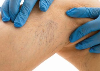 Οι κιρσοί των κάτω άκρων στην εγκυμοσύνη