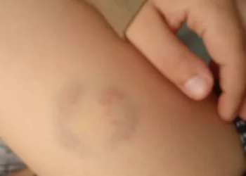 Άρτα: Διευθύντρια σχολείου δάγκωσε 11χρονο μαθητή ΑΜΕΑ