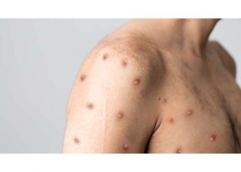 Μίνα Γκάγκα:«Αν δεν υπάρχουν εξανθήματα δεν μεταδίδεται η ευλογιά των πιθήκων»